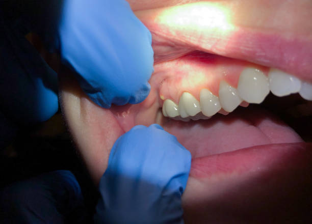 Best Emergency Dentist for Lost Fillings or Crowns in Murfreesboro, AR