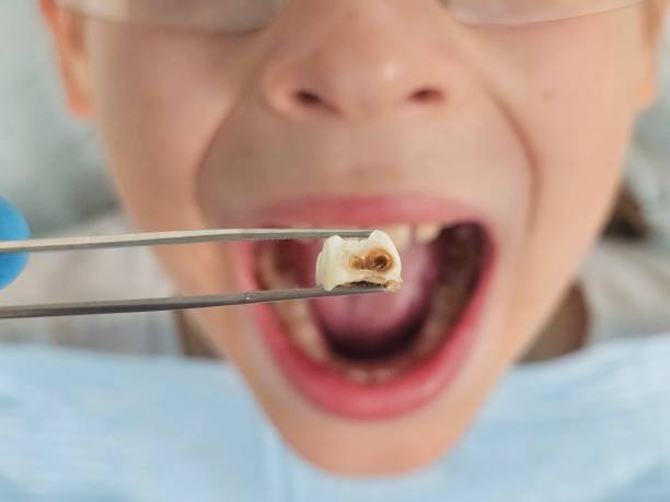 Best Emergency Dentist for Knocked-Out Tooth in Murfreesboro, AR